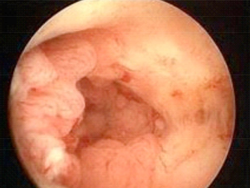 Hiperplasia endometrial