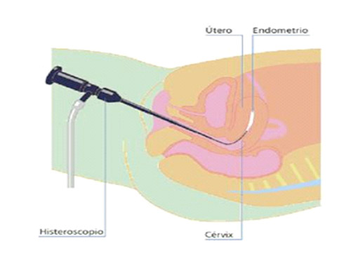 Histeroscopia