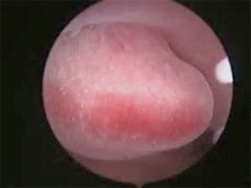 Pólipo Endometrial